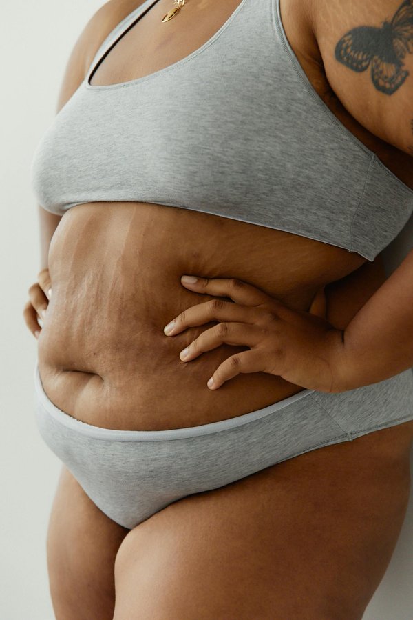 Dermopigmentation vergeture : témoignages et résultats convaincants